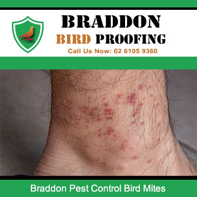 Health effects of bird mites showing need for pest control in Braddon